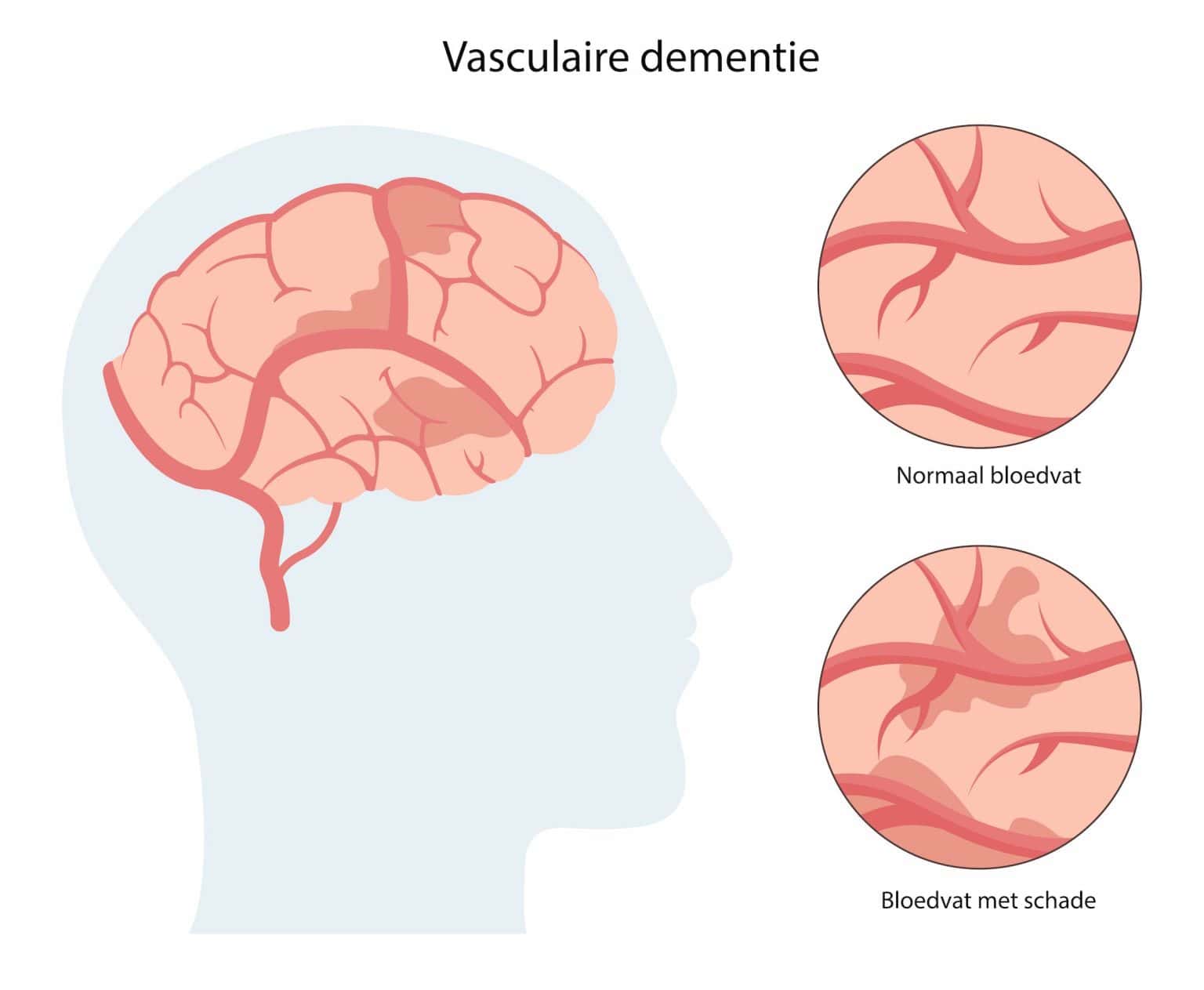 Wat Zijn De Eerste Tekenen Van Vasculaire Dementie