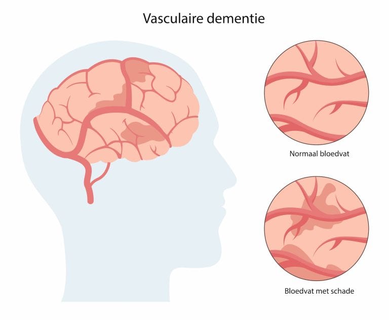Vasculaire dementie