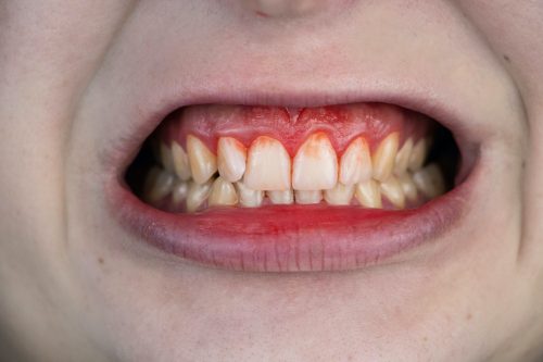 Kunnen vitamine C supplementen een verkoudheid voorkomen? 3 Vitamine C scheurbuik