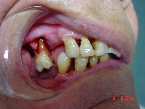 Mondgezondheid parodontale problemen